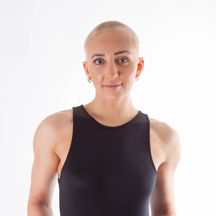 alopeciadiaries_